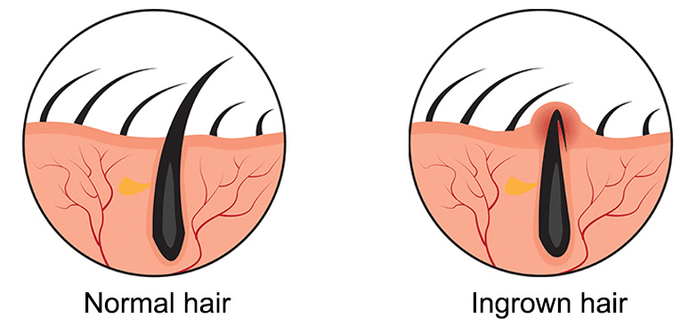 tea tree oil for ingrown hair vs normal hair