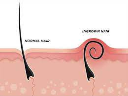 tea tree oil for ingrown hair vs normal hair