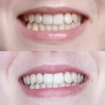 Coconut Oil For Teeth Whitening: How Does It Work?