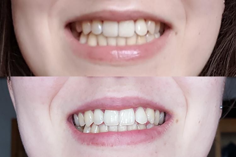 before and after comparison of teeth after coconut oil teeth pulling - coconut oil for teeth whitening
