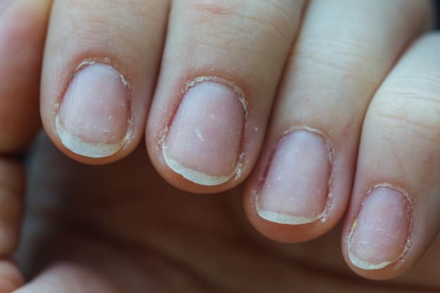 brittle nails - Coconut Oil For Nails