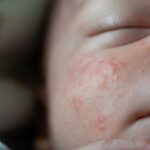 close up shot of a baby's face with eczema - jojoba oil for baby eczema