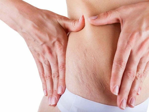 Can I Use Jojoba Oil for Stretch Marks?


Jojoba Oil for Stretch Marks: Benefits and Precautions 

If you have stretch marks, you’re not alone. Most people experience them at some point in their lives. While there are many treatments available, the good news is that you can also use natural remedies such as jojoba oil to reduce the appearance of stretch marks. Let’s look at the benefits of using jojoba oil for stretch marks, as well as a few precautions to keep in mind. 





How To Use Jojoba Oil For Stretch Marks?



The best way to use jojoba oil for stretch marks is to apply it directly onto the affected area. You can either massage it with your fingertips or use a cotton ball. Massaging the oil into the skin helps promote circulation, which can help reduce the appearance of stretch marks over time. Be sure to use gentle strokes and keep repeating the process until all of the oil is absorbed. It’s also important to use only a small amount at a time, as too much can clog pores and lead to skin irritation. After application, you may want to cover the area with a warm compress for 10 minutes or so to help reduce inflammation and promote healing.





Benefits of Using Jojoba Oil for Stretch Marks 





1. Jojoba oil is a powerful natural remedy for stretch marks as it works to keep the skin hydrated and nourished. The oil contains vitamins A, D, and E, along with a number of essential fatty acids that help to promote skin elasticity. 



2. This oil helps to reduce the appearance of stretch marks by helping reduce the inflammation caused by rapid stretching or weight gain. It can also improve the tone and texture of the affected area, making it look smoother and more even in tone. 



3. Unlike other oils, jojoba oil doesn't leave behind an oily residue on your skin after application - making it ideal for sensitive skin types that are more prone to irritation from other oils. 



4. Jojoba oil has anti-aging properties which help improve collagen production and help prevent wrinkles from forming on your skin due to rapid changes in size and shape caused by stretch marks. 



5. The antioxidant properties of jojoba oil protect against free radical damage which can cause premature aging as well as discoloration or darkening of the affected area due to sun exposure. 



6. The natural emollient properties of jojoba oil make it an effective moisturizer - especially when combined with other natural ingredients such as aloe vera or shea butter – providing intense hydration without leaving behind residue or clogging pores while reinforcing your skins protective barrier against environmental pollutants. 



7. Using this oil on a regular basis will help increase cell turnover which is vital for healthy looking skin, as well as promoting healing for any existing scars or lesions due to stretch marks. 



8. Jojoba oil can also be used to treat acne, eczema, psoriasis, and other skin conditions that may be associated with stretch marks - thus allowing you to treat multiple issues at once! 



9. Regular massage with jojoba oil not only increases circulation but also helps your body release toxins that can accumulate at areas where stretch marks occur - promoting optimum overall health in the process!  



10. Lastly, jojoba oil is easily absorbed into the skin making it an ideal choice for massaging into areas affected by stretch marks without leaving behind greasy residue - plus it's all-natural so there are no synthetic chemicals being absorbed into your body either!

Precautions While Using Jojoba Oil for Stretch Marks 

Although jojoba oil is natural and free from side effects, it’s important to take certain precautions when using it for treating stretch marks. First, be sure to test a small patch of your skin before applying it on larger areas with stretch marks. This will ensure that your skin won't react negatively to the jojoba oil. Additionally, always use a clean cotton swab or ball when applying jojoba oil so as not to spread any bacteria on your skin while trying to treat it. Lastly, if you experience any irritation or discomfort after using jojoba oil on your stretch marks, stop using it immediately and consult with your doctor or dermatologist if necessary. 


Can I Use Jojoba Oil for Stretch Marks Every Day?


Jojoba oil can be used on a regular basis for reducing the appearance of stretch marks, however, it’s important to take breaks in between applications. You can use it 2-3 times per week and then take a break for at least three days before using it again. This will keep your skin from becoming irritated or overly dry.  Additionally, be sure to apply moisturizer after each use of jojoba oil to keep your skin hydrated and further reduce the appearance of stretch marks. 


Does Jojoba Oil Tighten Skin?


Jojoba oil is known for its skin healing and anti-inflammatory properties, but it does not have any tightening or toning effect on the skin. So if you are looking to tighten your skin, jojoba oil may not be the best option. However, when used regularly in conjunction with moisturizers and other natural remedies such as aloe vera and shea butter, jojoba oil can help to reduce the appearance of stretch marks.  


Are Stretch Marks Preventable? 


Although there is no surefire way to prevent stretch marks, you can take certain measures to reduce the risk. Keeping your skin properly hydrated and maintaining a healthy diet rich in vitamins and minerals can help reduce the chances of developing stretch marks. Additionally, avoiding sudden weight gain or loss will make it less likely that you’ll end up with stretch marks. If you do experience stretch marks, jojoba oil can help reduce their appearance. 

Is Jojoba Oil Good for Pregnant Belly?


Yes, jojoba oil is a safe and effective option for pregnant women looking to reduce the appearance of stretch marks. When used regularly with other natural remedies such as aloe vera and shea butter, jojoba oil can help keep the skin hydrated while reducing the appearance of stretch marks. However, it's important to consult with your doctor before using any remedy while pregnant. 


Does Jojoba Oil Have Side Effects on Stretch Marks?


No, jojoba oil is a natural remedy with no known side effects. However, it is still important to test a small area of skin before using it on larger areas and consult with your doctor if you experience any irritation or discomfort after use. Additionally, always make sure to clean the cotton swab or ball used for applying jojoba oil to reduce the risk of spreading bacteria. 



While some people may experience mild side effects when using jojoba oil such as dryness or irritation of the skin, these are rare cases and can be avoided by using small amounts on a limited area to start with.







Conclusion: 

Jojoba oil has many beneficial properties that make it an ideal remedy for reducing the appearance of stretch marks naturally. However, it's important to take certain precautions when using this all-natural remedy for treating stretch marks, such as testing a small patch of skin first before applying it more broadly and taking care not to spread any bacteria on your skin while doing so. With these tips in mind, you can incorporate jojoba oil into your daily skincare routine with confidence!