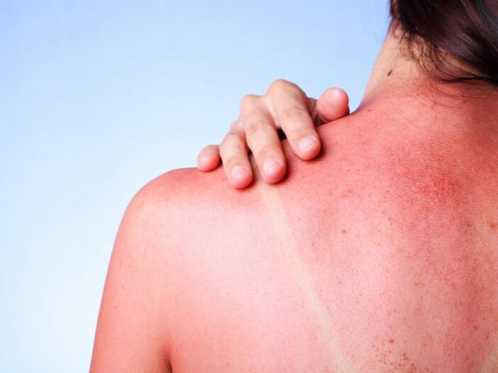 sunburn's on woman's back - Jojoba Oil for Sunburn