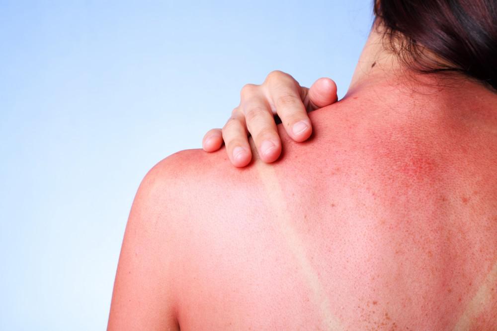  sunburn's on woman's back - Jojoba Oil for Sunburn